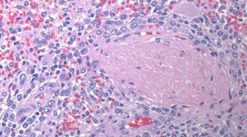 marginal zone lymphoma