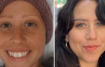 Split image of Racheli, Hodgkin lymphoma survivor. On the right, her during treatment. On the left, post-treatment.