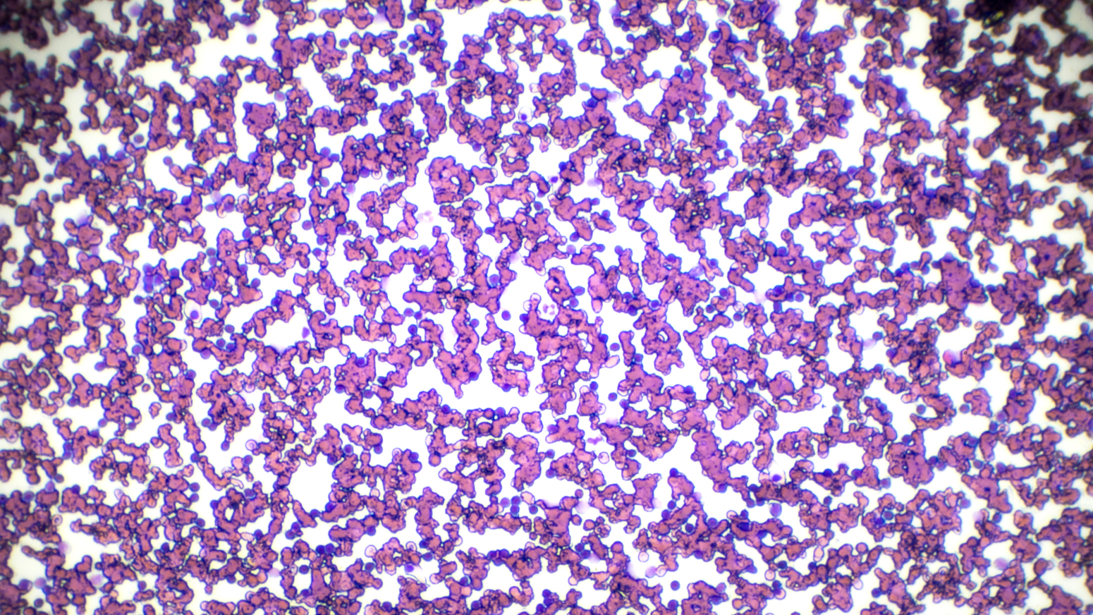 microscope image of leukemia cells