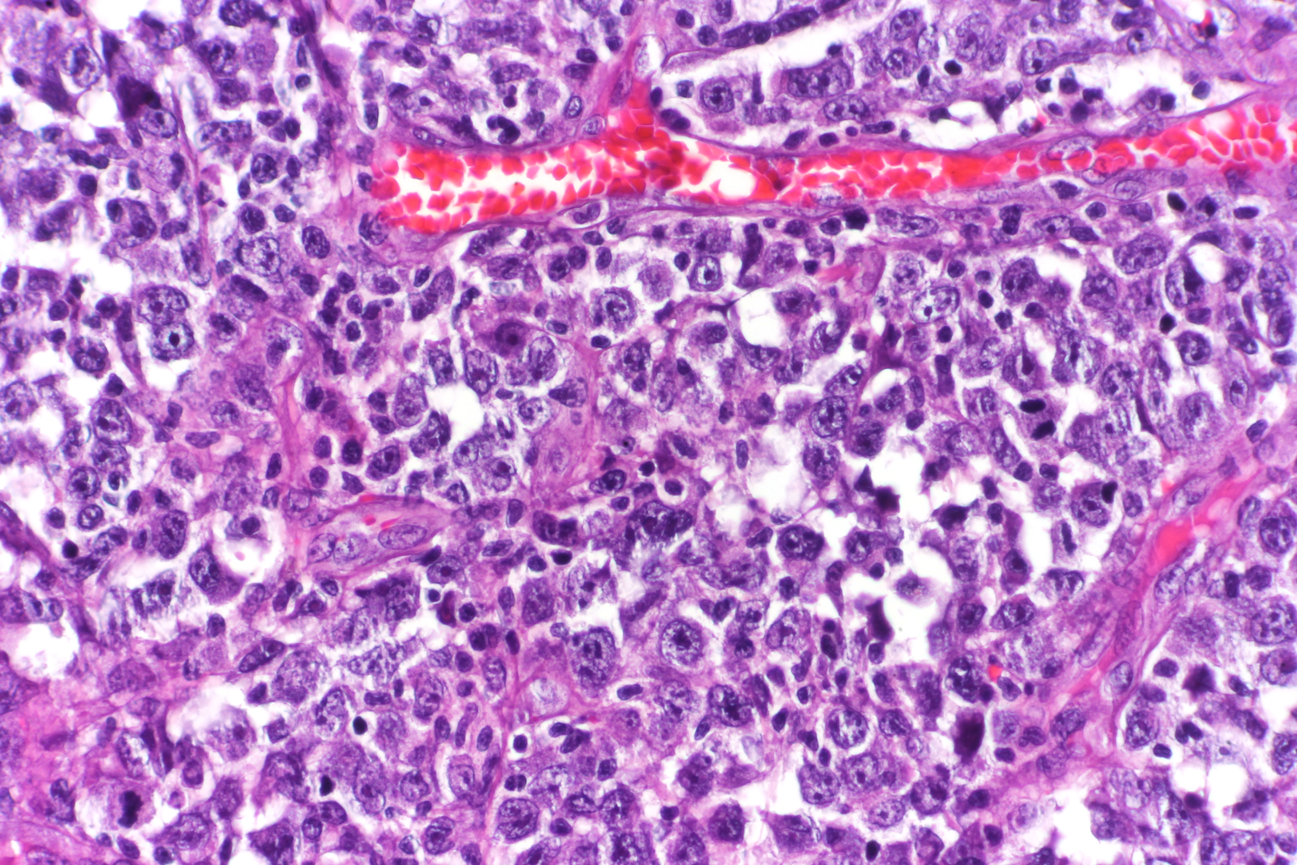 Large Diffuse B Cell Lymphoma