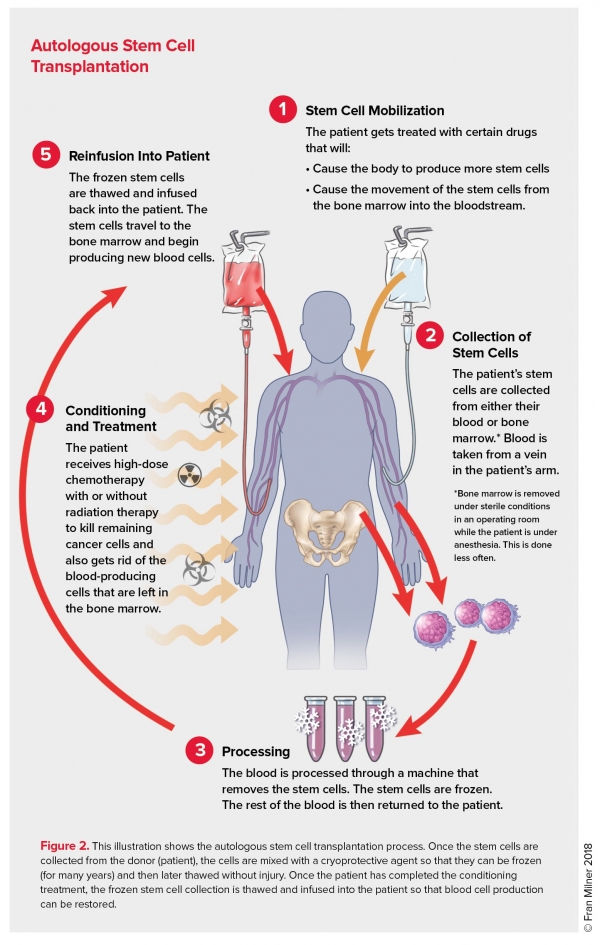 National Cancer Institute - What are bone marrow transplantation and  peripheral blood stem cell transplantation? These procedures restore stem  cells that have been destroyed by high doses of chemotherapy and/or  radiation therapy