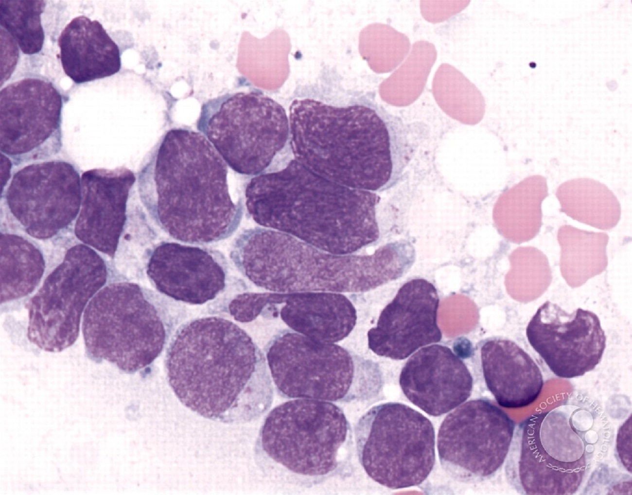 Acute Lymphoblastic Leukemia (ALL) | Leukemia and Lymphoma Society