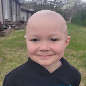 acute lymphoblastic leukemia (B-ALL)