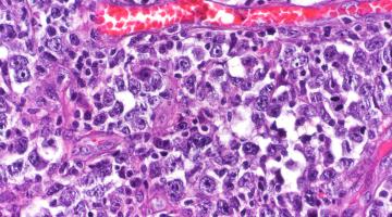 Diffuse large b-cell lymphoma
