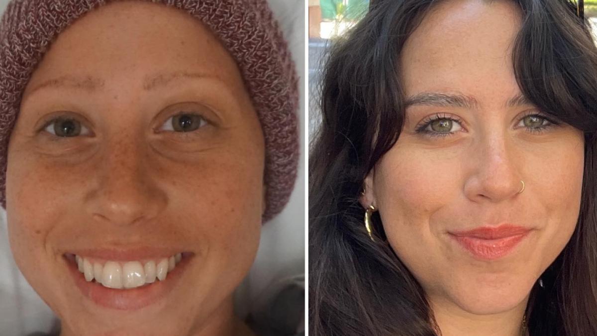 Split image of Racheli, Hodgkin lymphoma survivor. On the right, her during treatment. On the left, post-treatment.